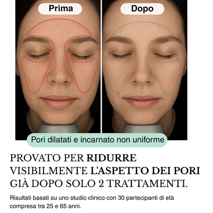 Sistema ad infusione Microneedling Anti-age