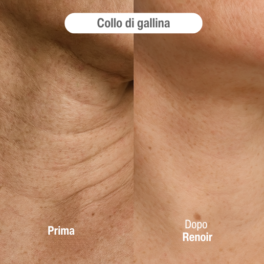 Sistema ad infusione Microneedling Anti-age